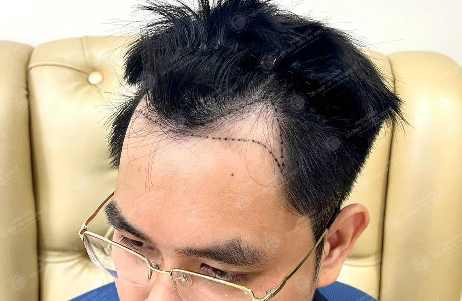 Nguyễn Văn Nam - Cấy tóc đường chữ M 3