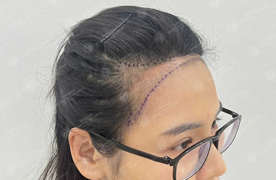 Phạm Thị Trang - Cấy tóc đường chữ M 3
