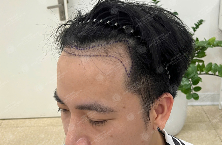 Nguyễn Tiến Hiệp - Cấy tóc đường chữ M 3