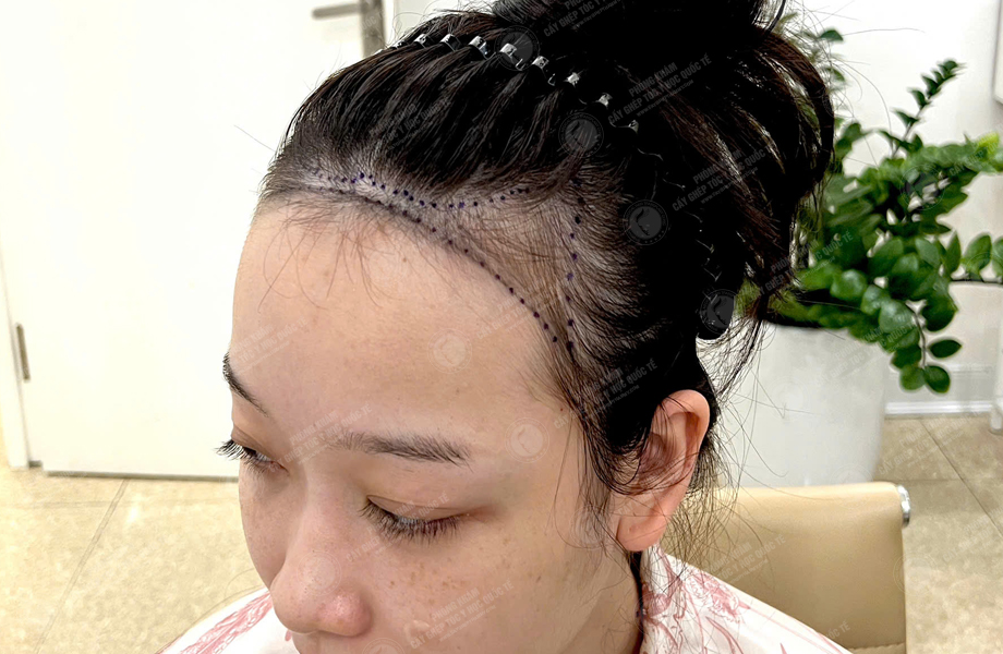 Nguyễn Kim Dung - Cấy tóc đường chữ M 3