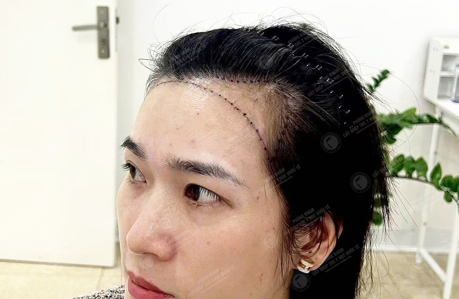 Lê Thị Nhi - Cấy tóc đường chữ M 3