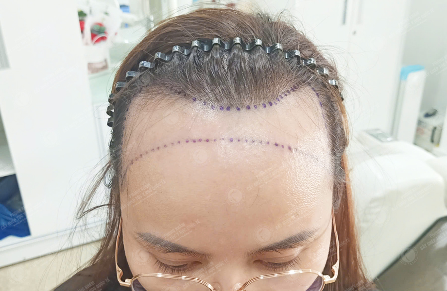 Phạm Thị Huệ - Cấy tóc đường chữ M 3