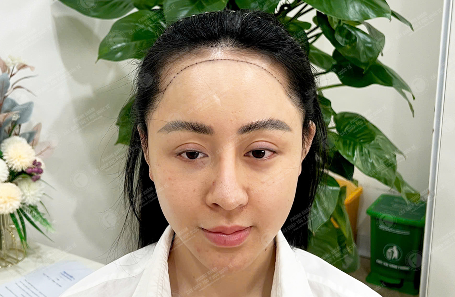 Nguyễn Ngọc Hân - Cấy tóc đường chữ M 3