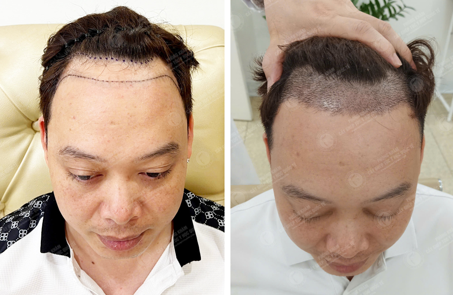 Nguyễn Quốc Đoàn - Cấy tóc đường chữ M 2