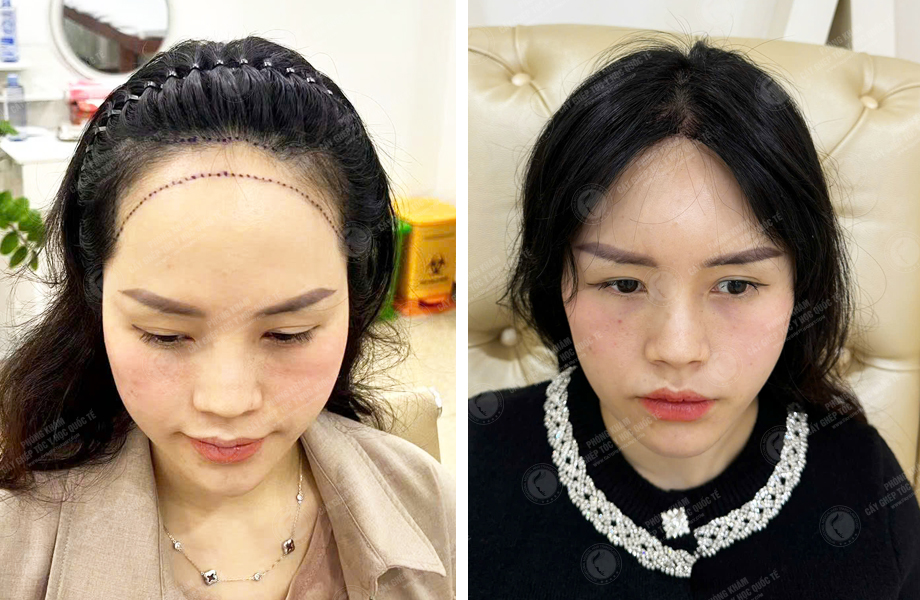  Nguyễn Thu Trà - Cấy tóc đường chữ M 1