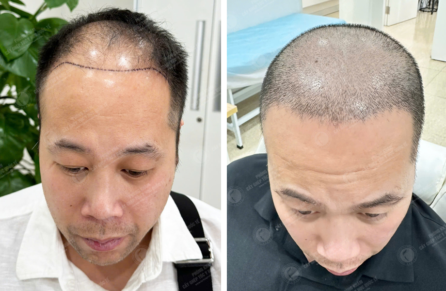  Nguyễn Duy Sơn - Cấy tóc đường chữ M 1