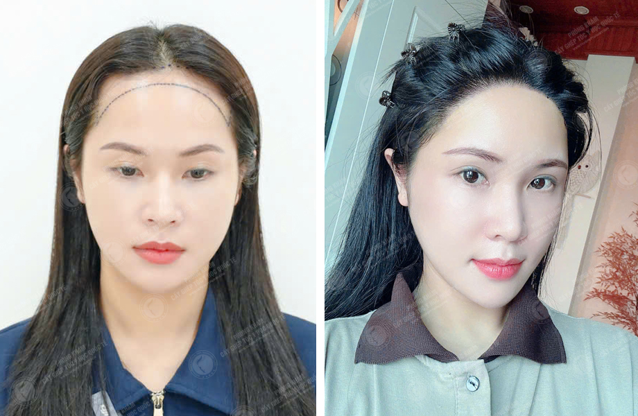  Hoàng Ngọc Linh - Cấy tóc đường chữ M 1