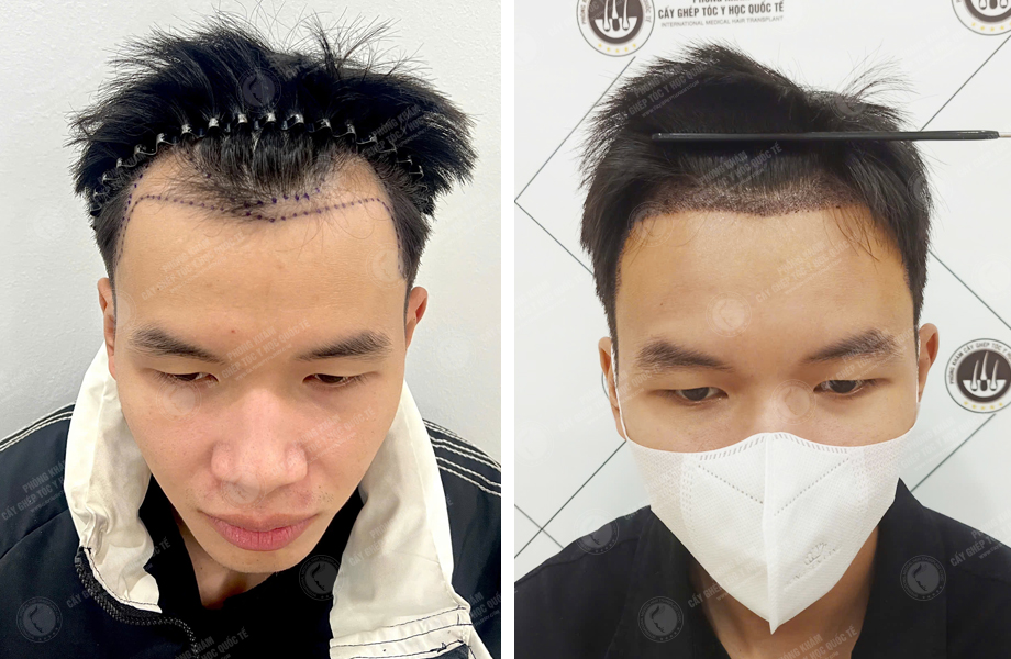  Trần Tuấn Hùng - Cấy tóc đường chữ M 1