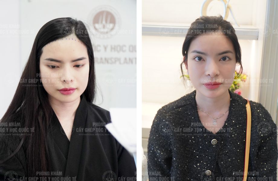  Đỗ Thanh Tuyền - Cấy tóc tự thân 1