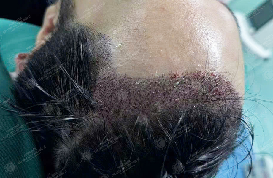 Phan Tùng Lâm - Cấy tóc đường chữ M 4