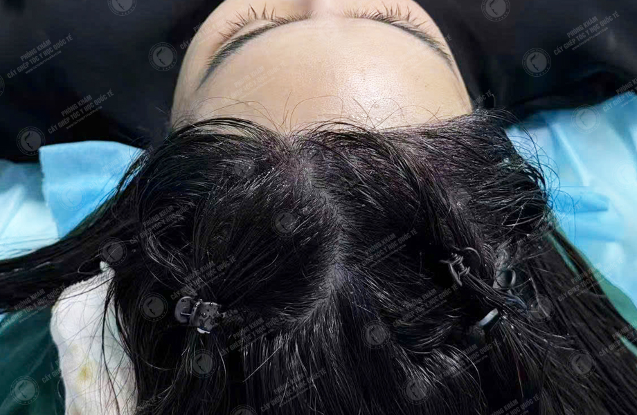 Huỳnh Bảo Ngân - Cấy tóc đường chữ M 4