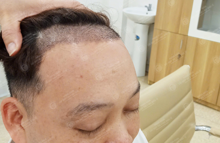 Nguyễn Quốc Đoàn - Cấy tóc đường chữ M 5