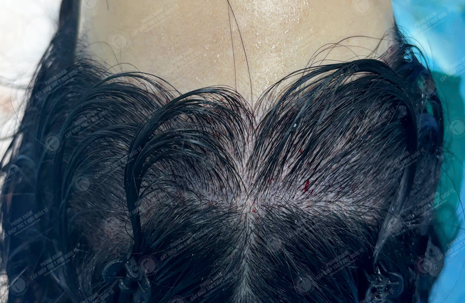 Nguyễn Thu Trà - Cấy tóc đường chữ M 4