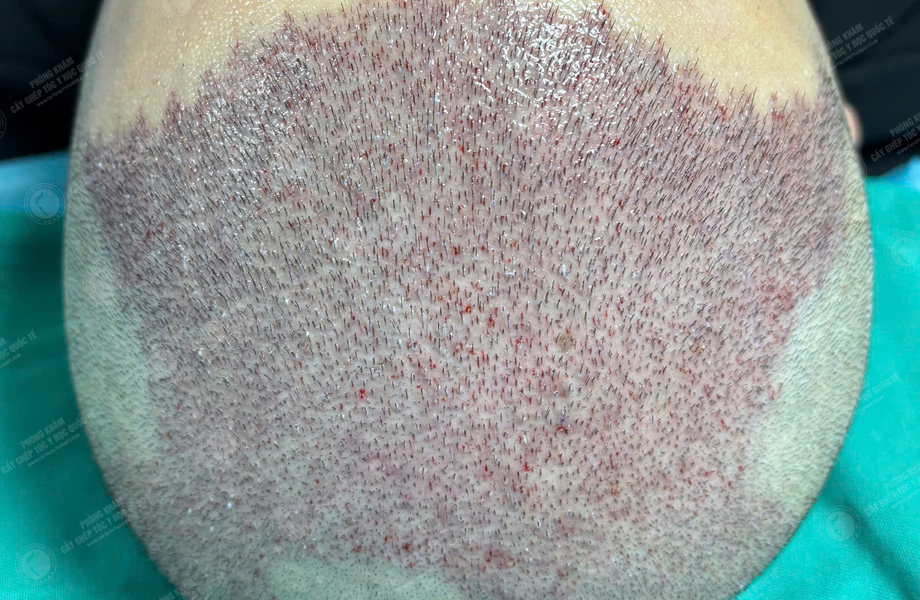 Nguyễn Duy Sơn - Cấy tóc đường chữ M 4