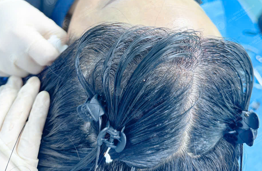 Hoàng Ngọc Linh - Cấy tóc đường chữ M 4