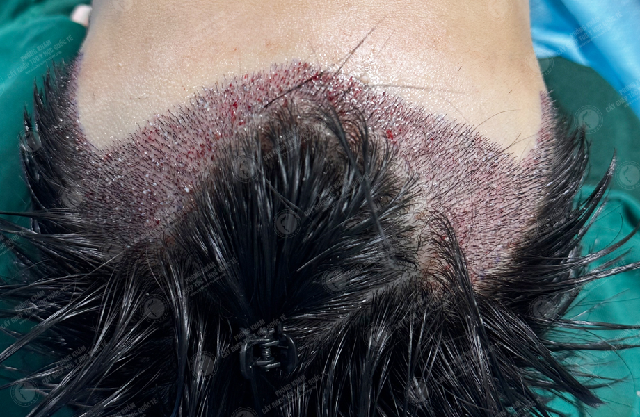 Trần Tuấn Hùng - Cấy tóc đường chữ M 4