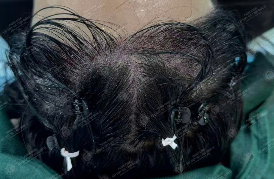 Nguyễn Thị Lan - Cấy tóc đường chữ M 4