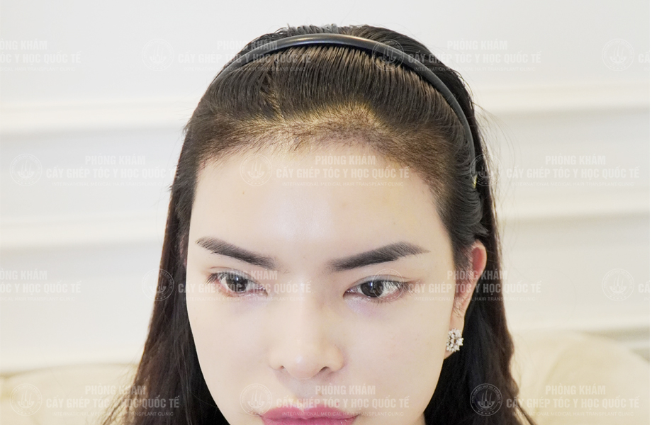 Đỗ Thanh Tuyền - Cấy tóc đường chữ M 4