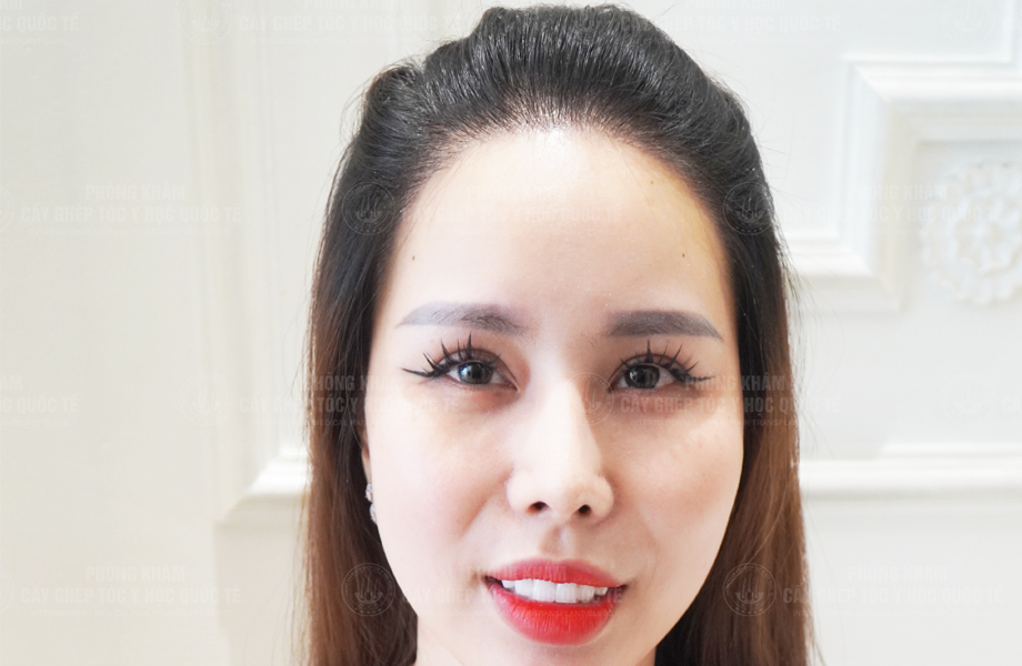 Nguyễn Nguyệt Nhi - Cấy tóc đường chữ M 4