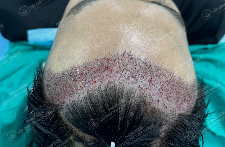 Vũ Quang Nam - Cấy tóc đường chữ M 4