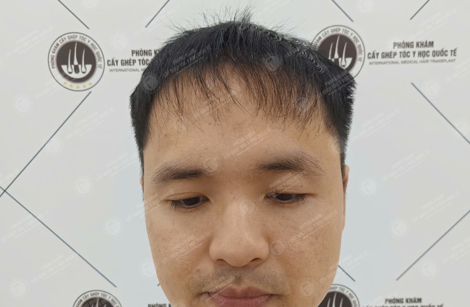 Nguyễn Văn Tùng - Cấy tóc đường chữ M 4