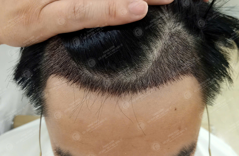 Nguyễn Văn Nam - Cấy tóc đường chữ M 4