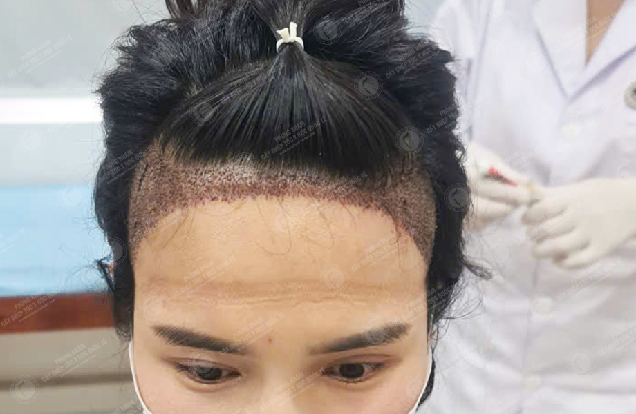 Phạm Thị Trang - Cấy tóc đường chữ M 4