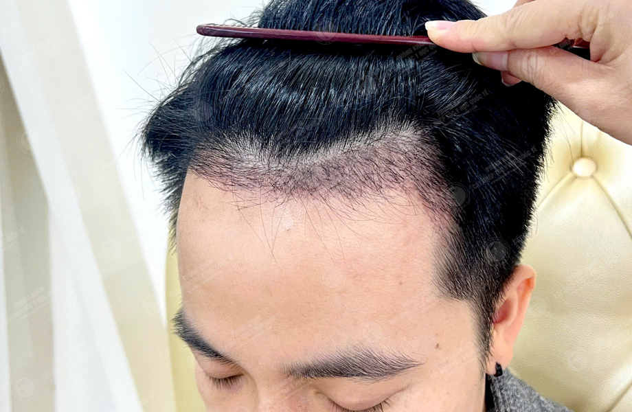 Nguyễn Tiến Hiệp - Cấy tóc đường chữ M 4