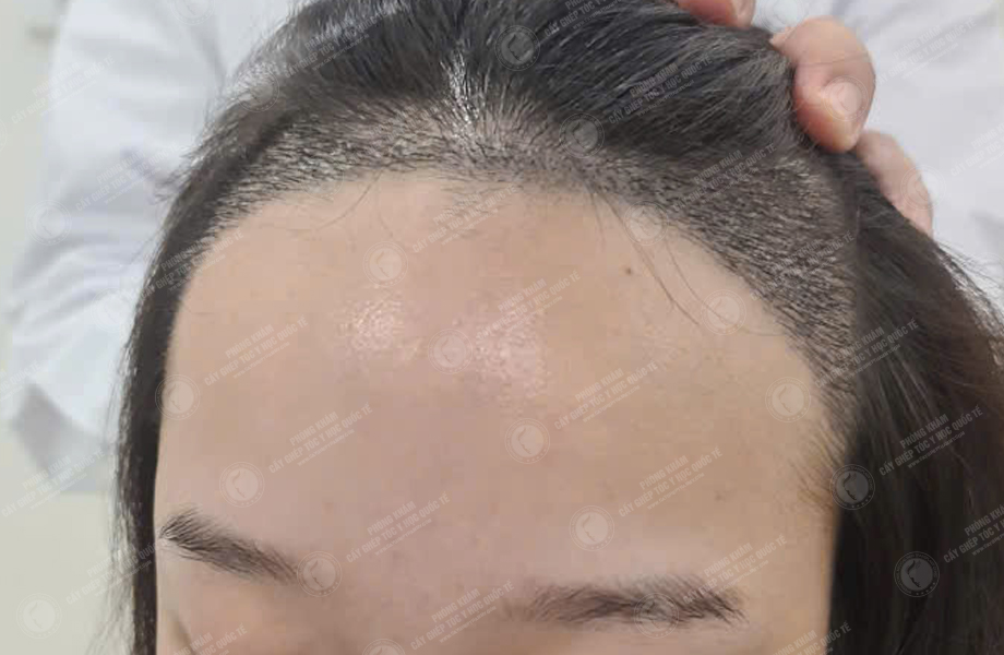 Nguyễn Kim Dung - Cấy tóc đường chữ M 4