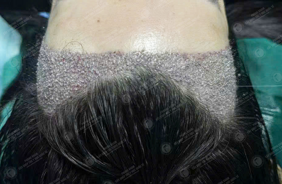 Lê Thị Nhi - Cấy tóc đường chữ M 4