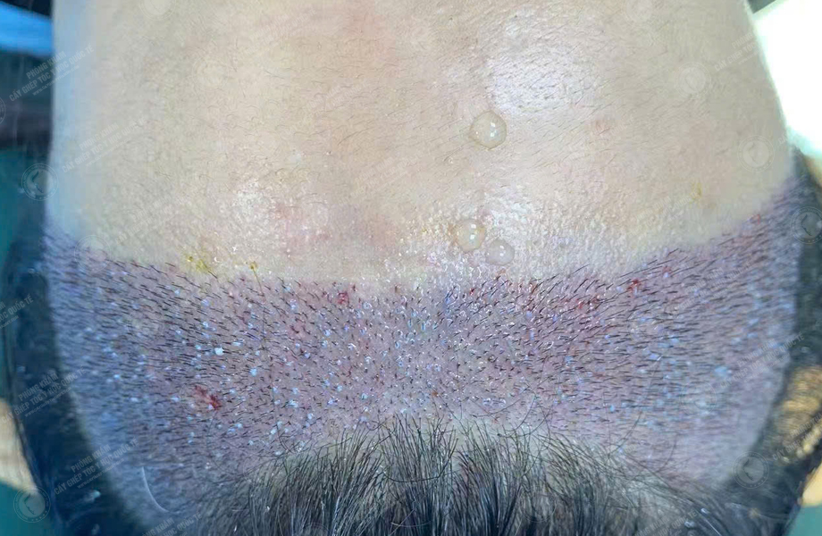 Phạm Thị Huệ - Cấy tóc đường chữ M 4