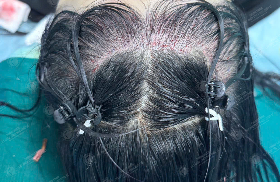 Nguyễn Ngọc Hân - Cấy tóc đường chữ M 4