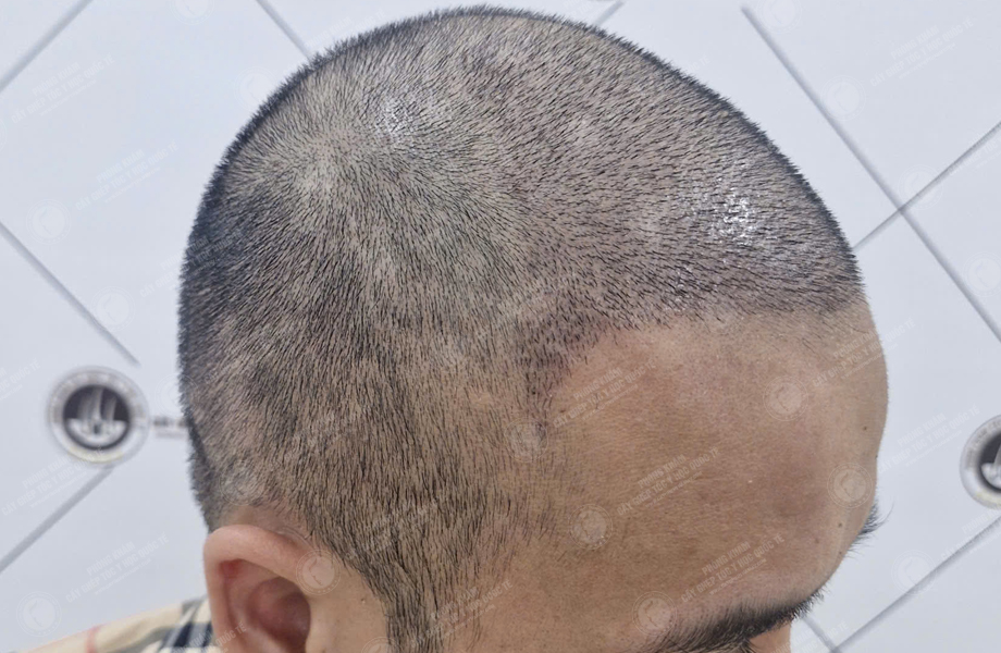 Phạm Đức Hùng - Cấy tóc đường chữ M 5