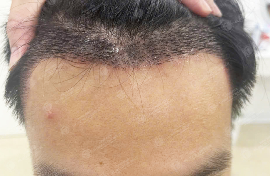 Phan Tùng Lâm - Cấy tóc đường chữ M 5