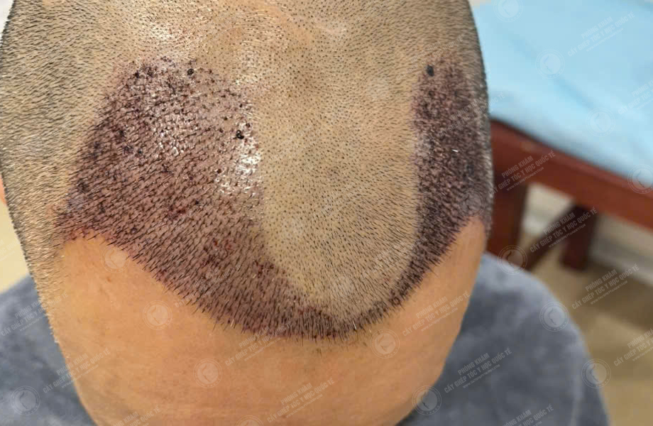 Trần Văn Toàn - Cấy tóc đường chữ M 5