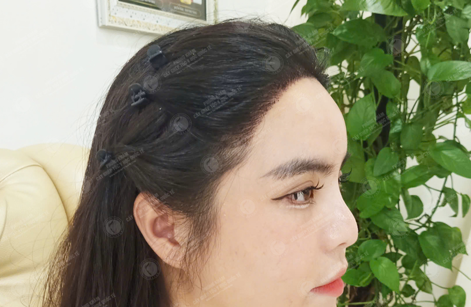 Huỳnh Bảo Ngân - Cấy tóc đường chữ M 5