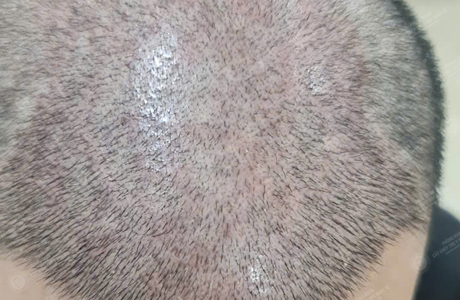 Nguyễn Văn Sơn - Cấy tóc đường chữ M 5