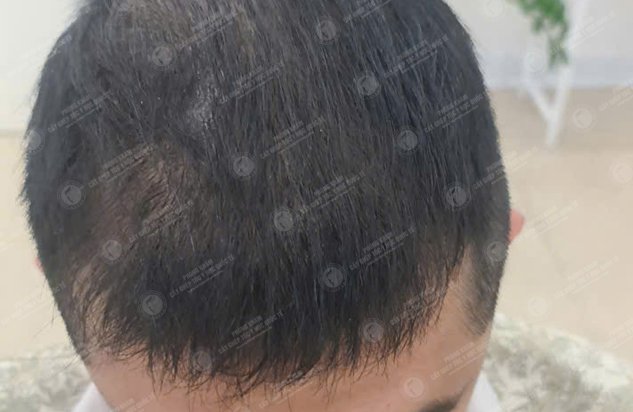 Lý Hoài Nam - Cấy tóc đường chữ M 5