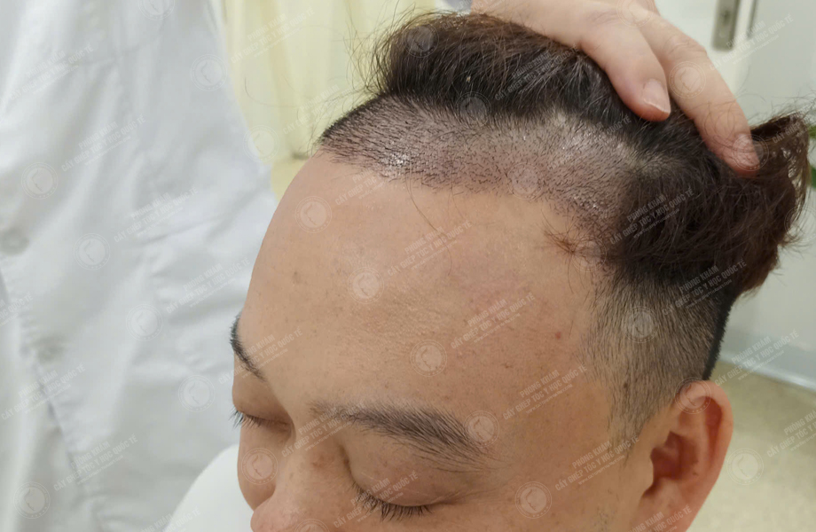 Nguyễn Quốc Đoàn - Cấy tóc đường chữ M 6