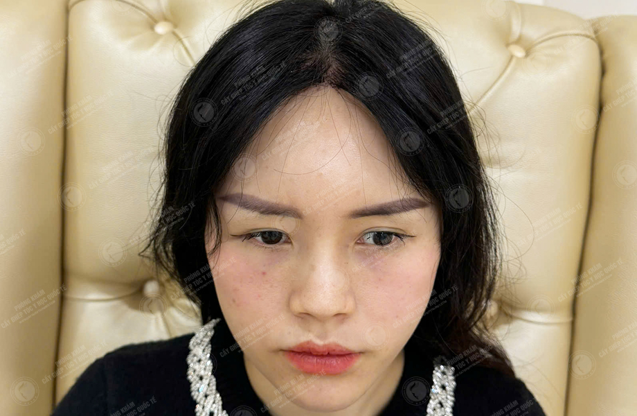 Nguyễn Thu Trà - Cấy tóc đường chữ M 5