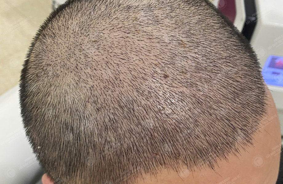 Nguyễn Duy Sơn - Cấy tóc đường chữ M 5