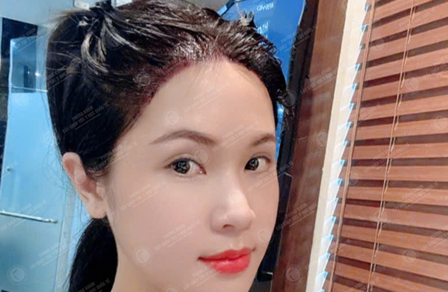 Hoàng Ngọc Linh - Cấy tóc đường chữ M 5