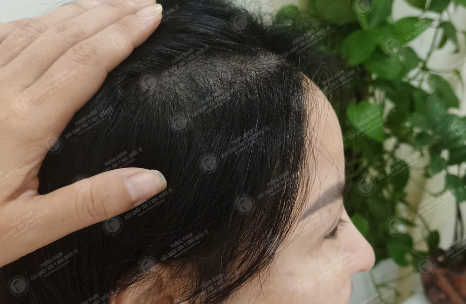 Nguyễn Thị Lan - Cấy tóc đường chữ M 5