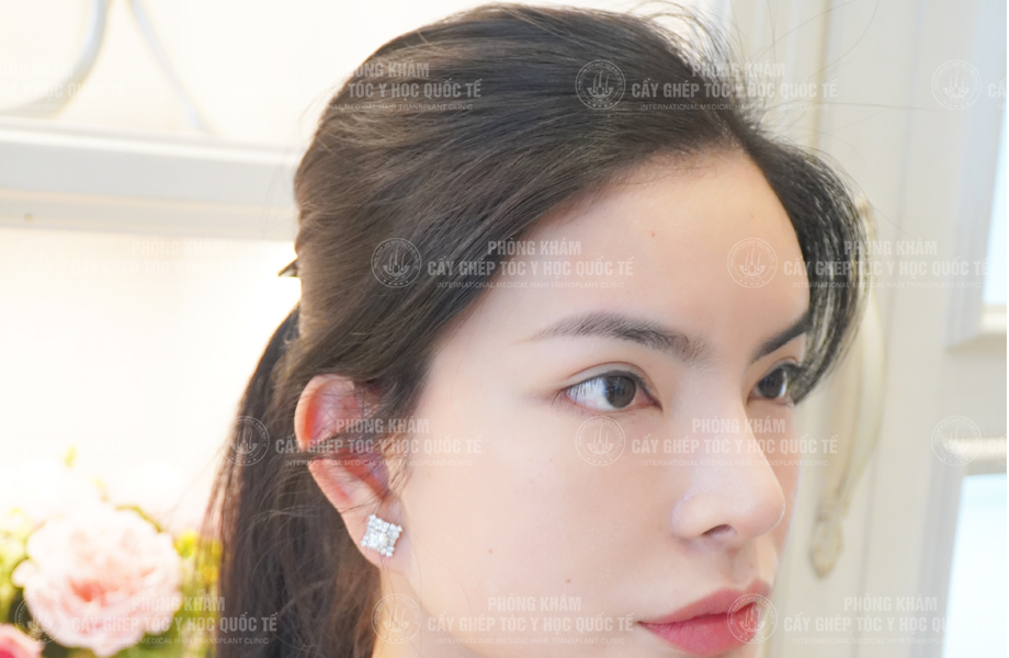 Đỗ Thanh Tuyền - Cấy tóc đường chữ M 5