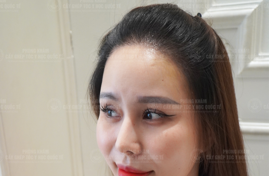 Nguyễn Nguyệt Nhi - Cấy tóc đường chữ M 5