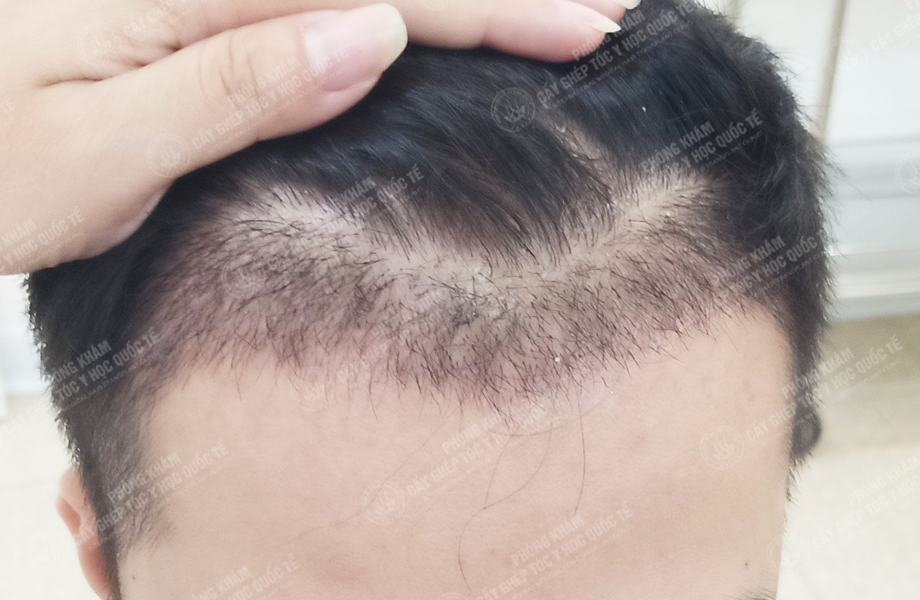 Vũ Quang Nam - Cấy tóc đường chữ M 5