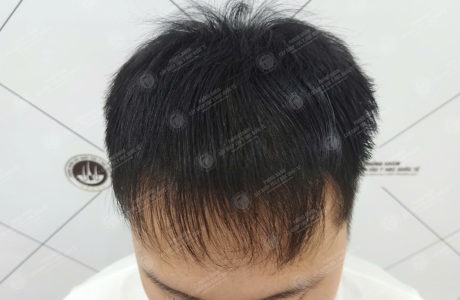 Nguyễn Văn Tùng - Cấy tóc đường chữ M 5