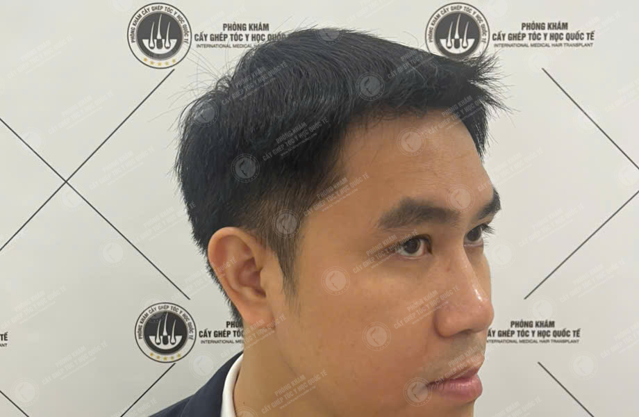 Nguyễn Văn Nam - Cấy tóc đường chữ M 5