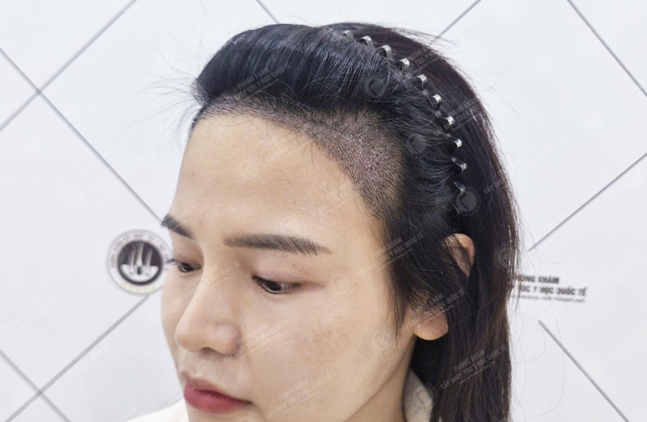 Phạm Thị Trang - Cấy tóc đường chữ M 5