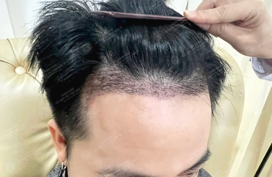 Nguyễn Tiến Hiệp - Cấy tóc đường chữ M 5